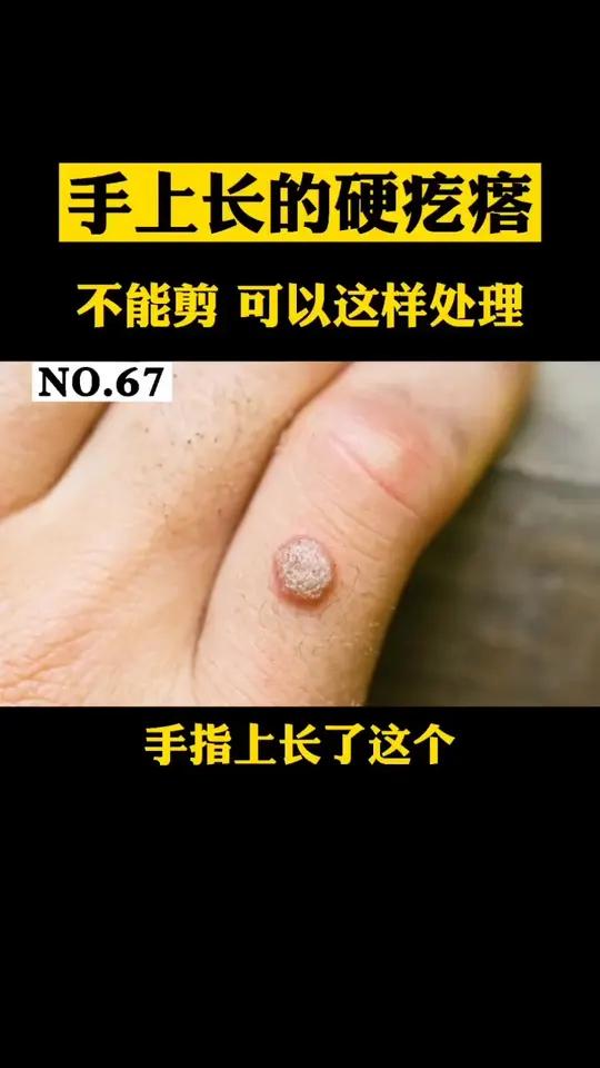 手上长了一块肉疙瘩,硬硬的很粗糙,剪了还会有,这个是寻常疣也叫瘊子,教你一招简单处理