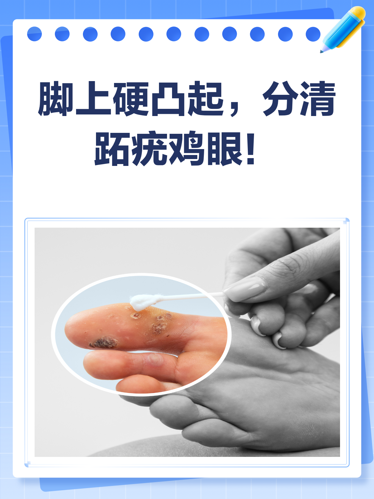 脚上硬凸起？揭秘跖疣、鸡眼的真相！