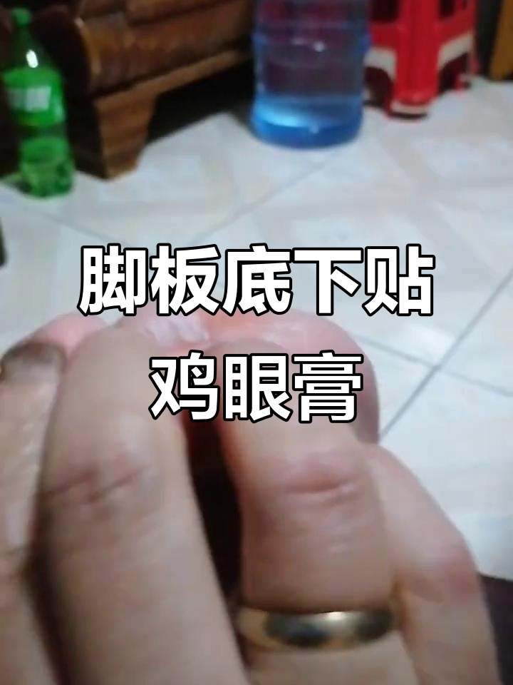 脚板底长鸡眼,拼多多买的药膏效果惊人