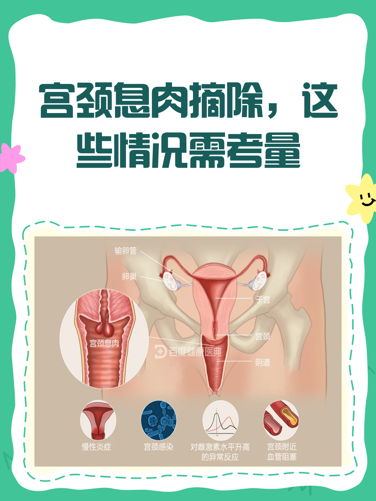 宫颈息肉不摘除？听听医生怎么说