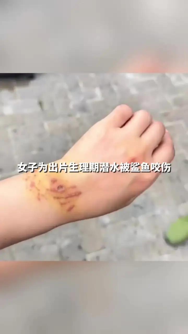 女子为出片生理期潜水被鲨鱼咬伤