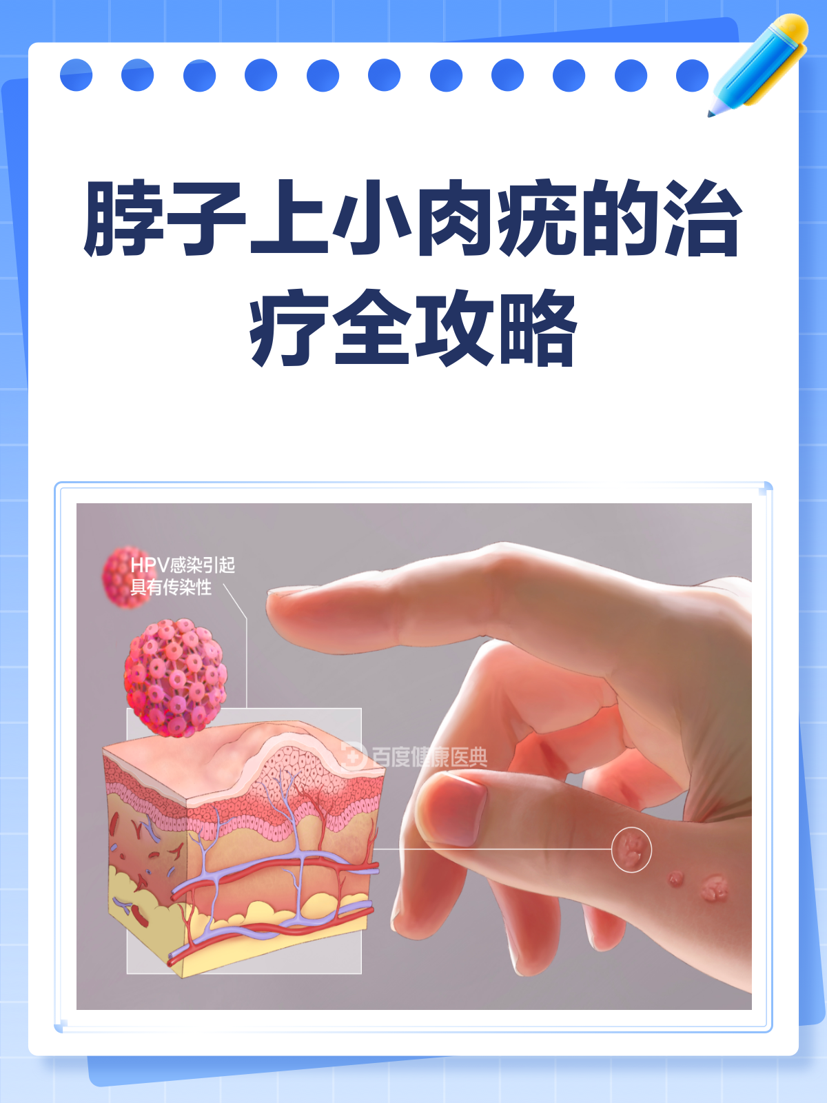 脖子上的小肉疣？别急，教你如何搞定它！