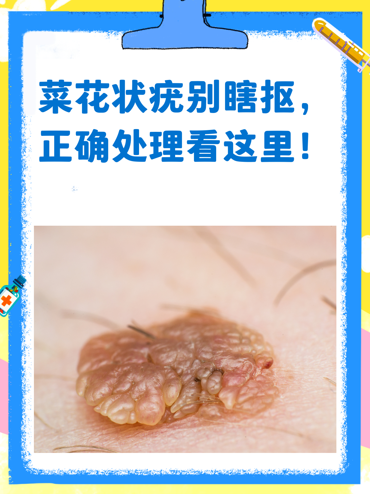 菜花状疣自己抠掉就万事大吉了