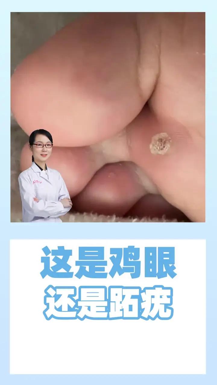 这是鸡眼 还是跖疣 这是鸡眼 还是跖疣