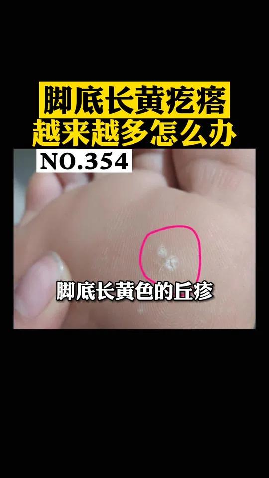 脚底长了像鸡眼一样的疙瘩,但是比较多,要小心是跖疣会传染