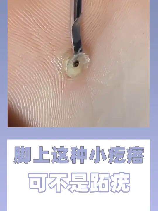 什么是鸡眼 鸡眼怎么治疗