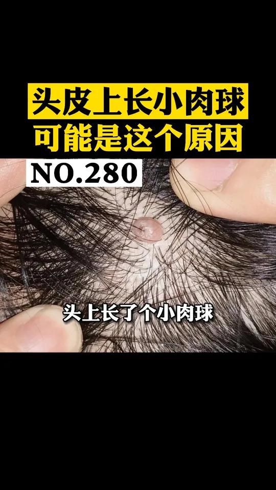 头皮上长了粉色小肉球,软软的,可能是这个原因