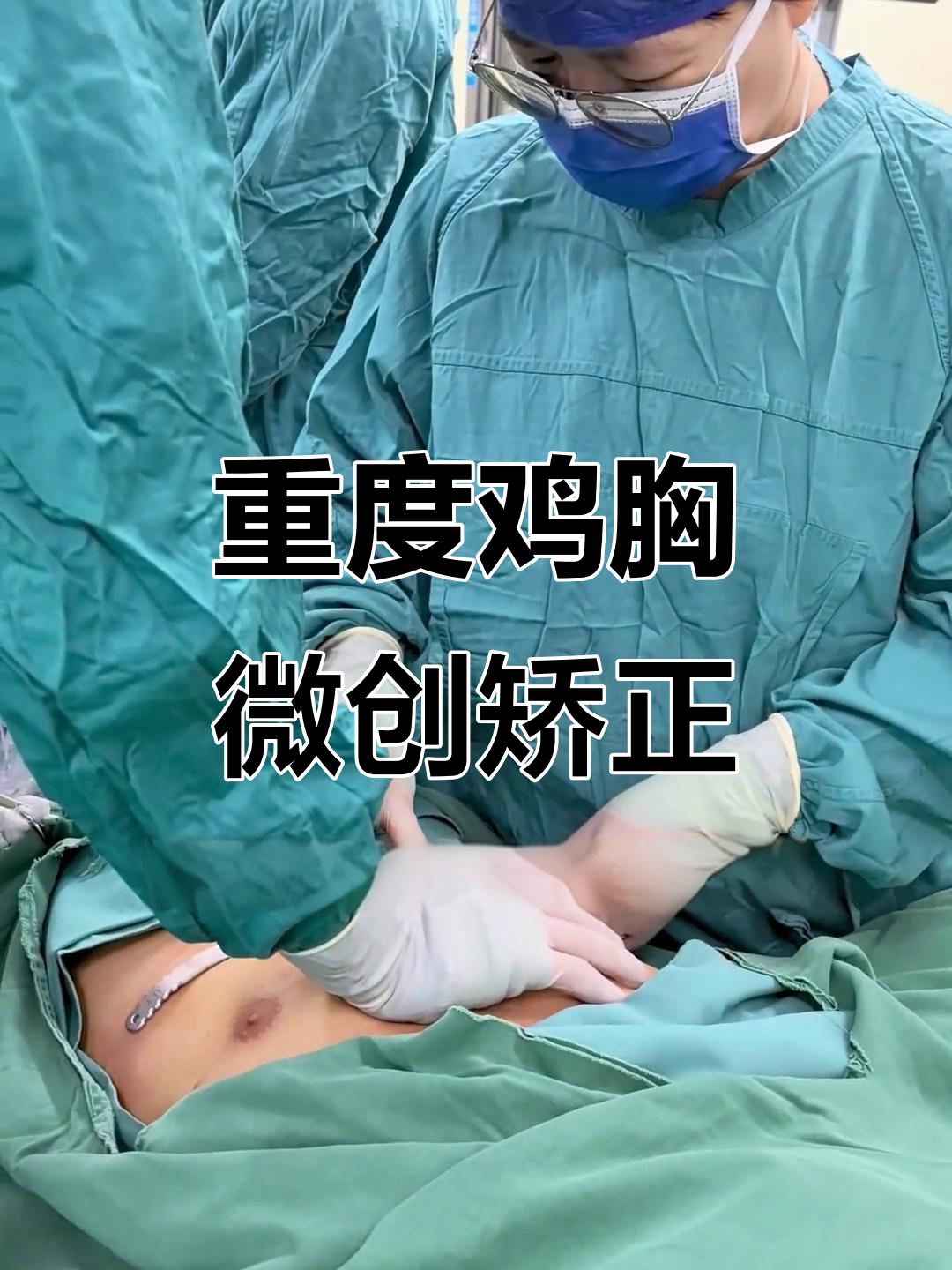 16岁男孩重度鸡胸手术,矫正效果惊人