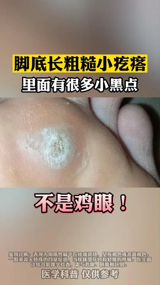 脚底板长小疙瘩,里面有很多小黑点,可别当鸡眼治!这是跖疣