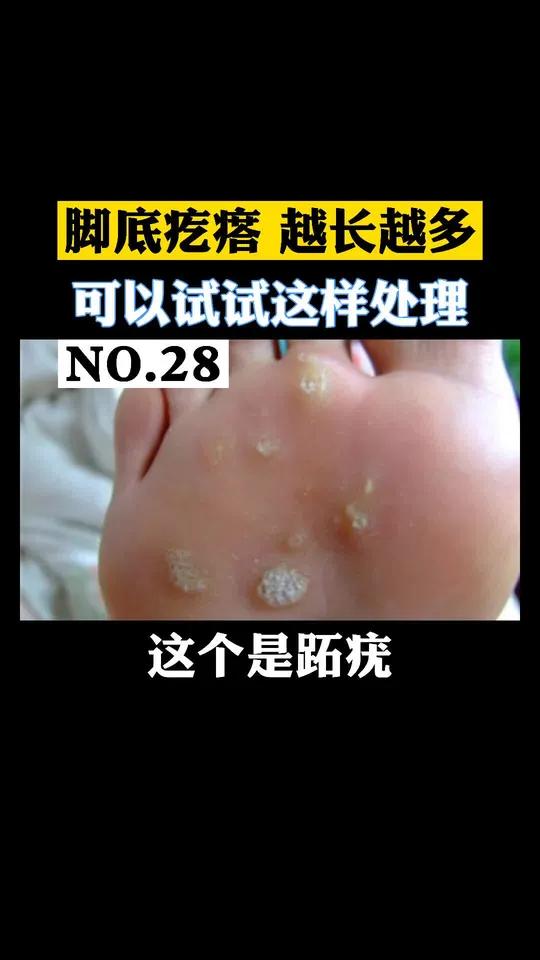 脚底长肉疙瘩,越长越多,可以这样处理