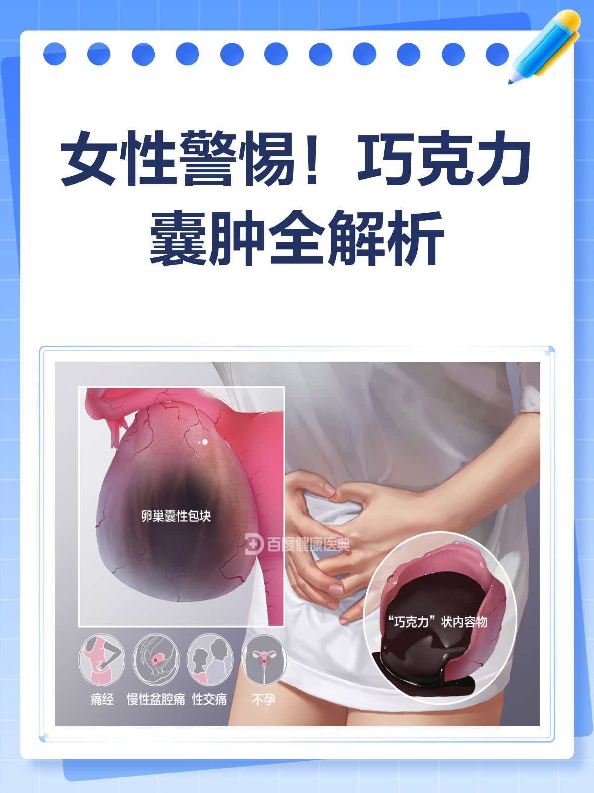 巧克力囊肿,这个“甜蜜”的烦恼怎么破?