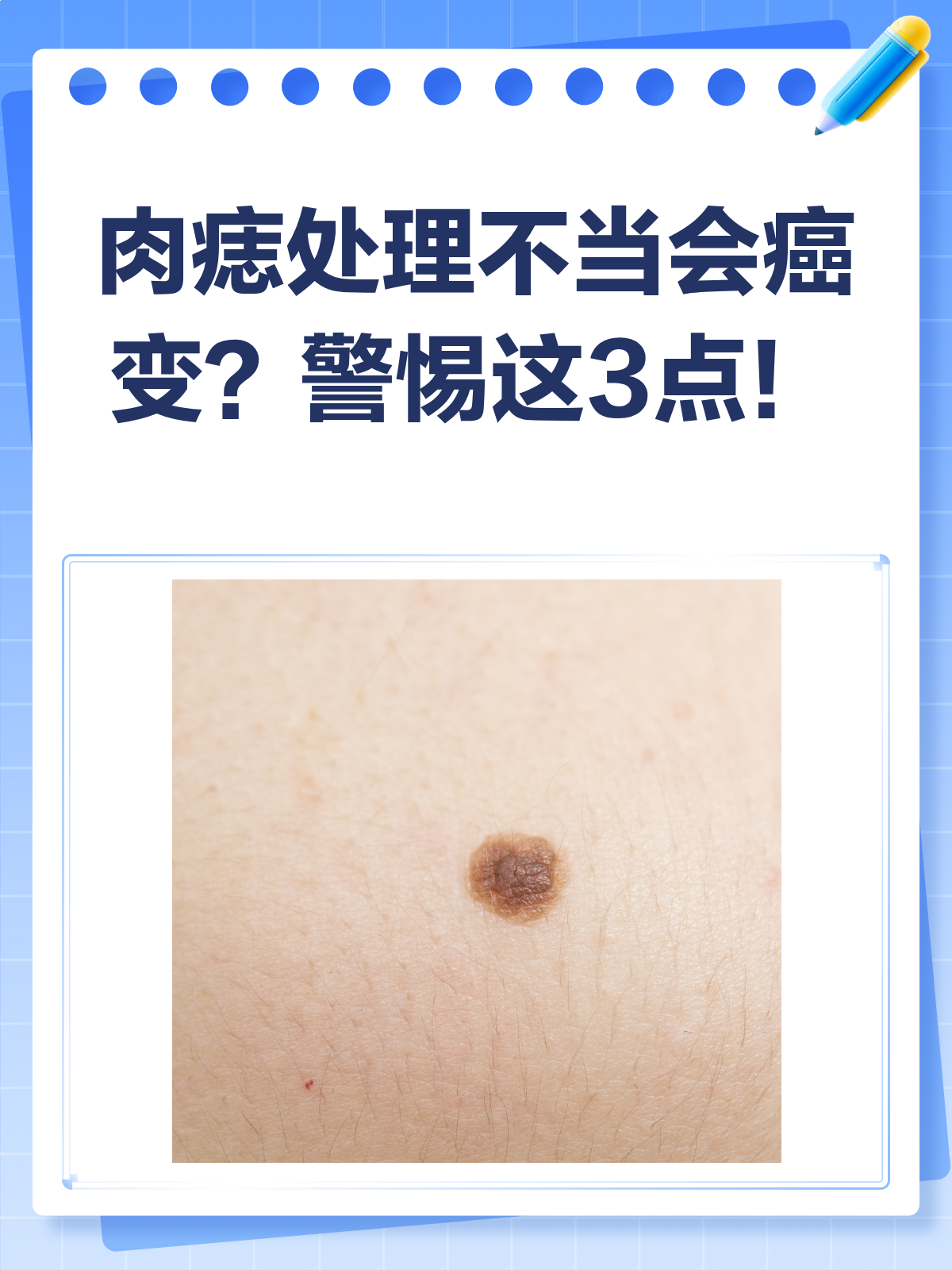 肉痣割了会癌变吗?正确处理很关键!