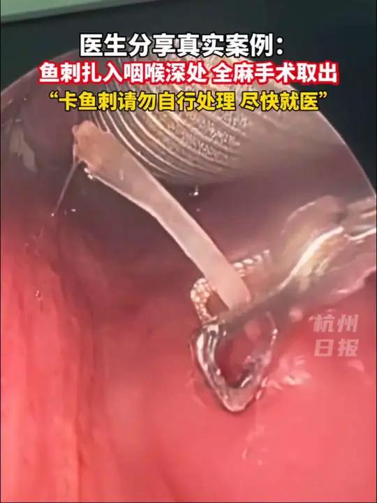 医生分享案例:鱼刺卡喉,全麻取出……请勿自行处理!