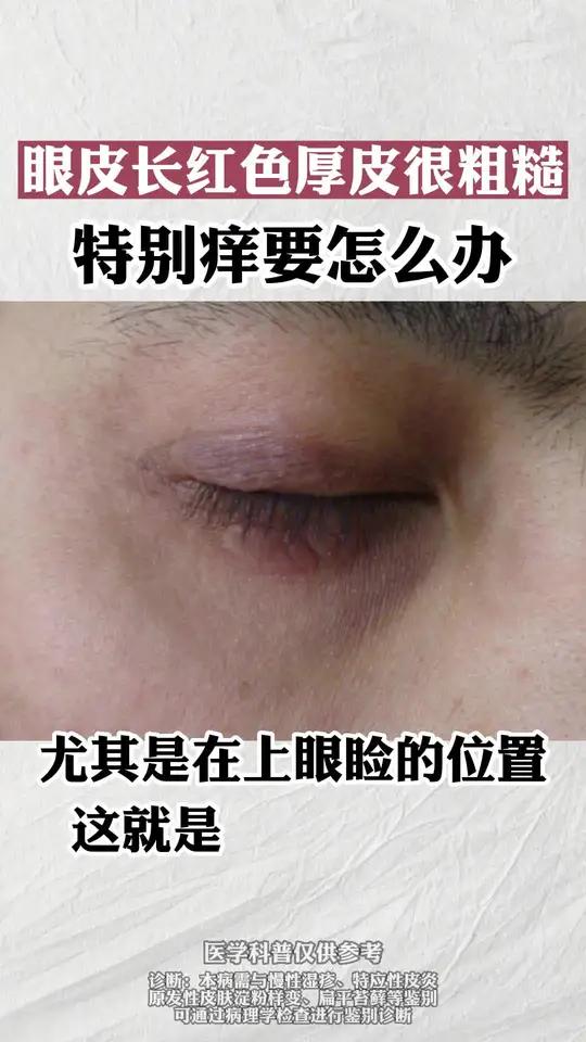 眼睛长苔藓样的皮疹,怎么办