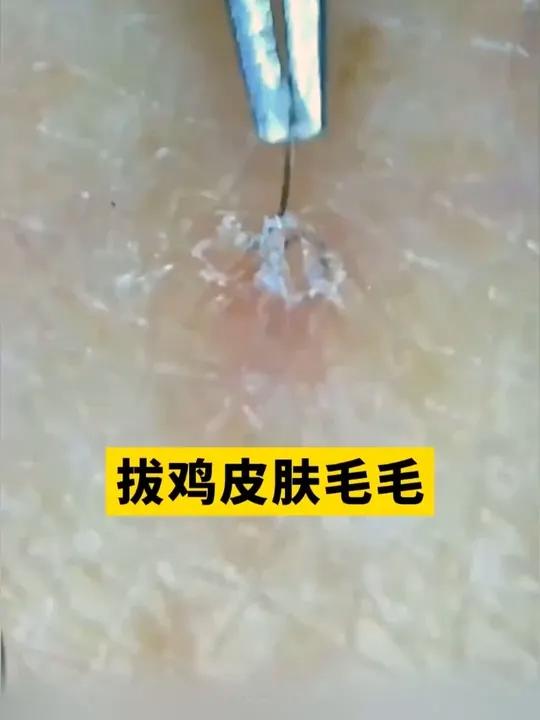 胳膊大腿长鸡皮肤疙疙瘩瘩扎手又难看,医生教你低成本处理!#鸡皮肤 #鸡皮疙瘩 #皮肤问题 