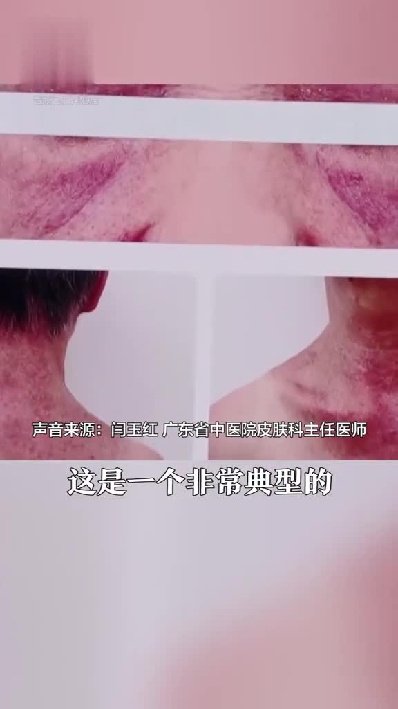 眼睛周围长这种红点,当心是癌症信号