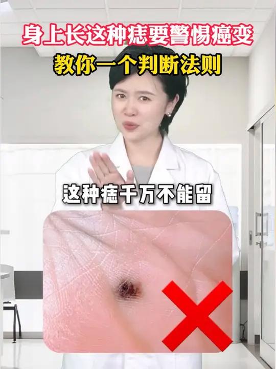 身上长这种黑痣要警惕,可能是恶性黑色素瘤!皮肤科医生教你一个“ABCDE”判断法则,一定要