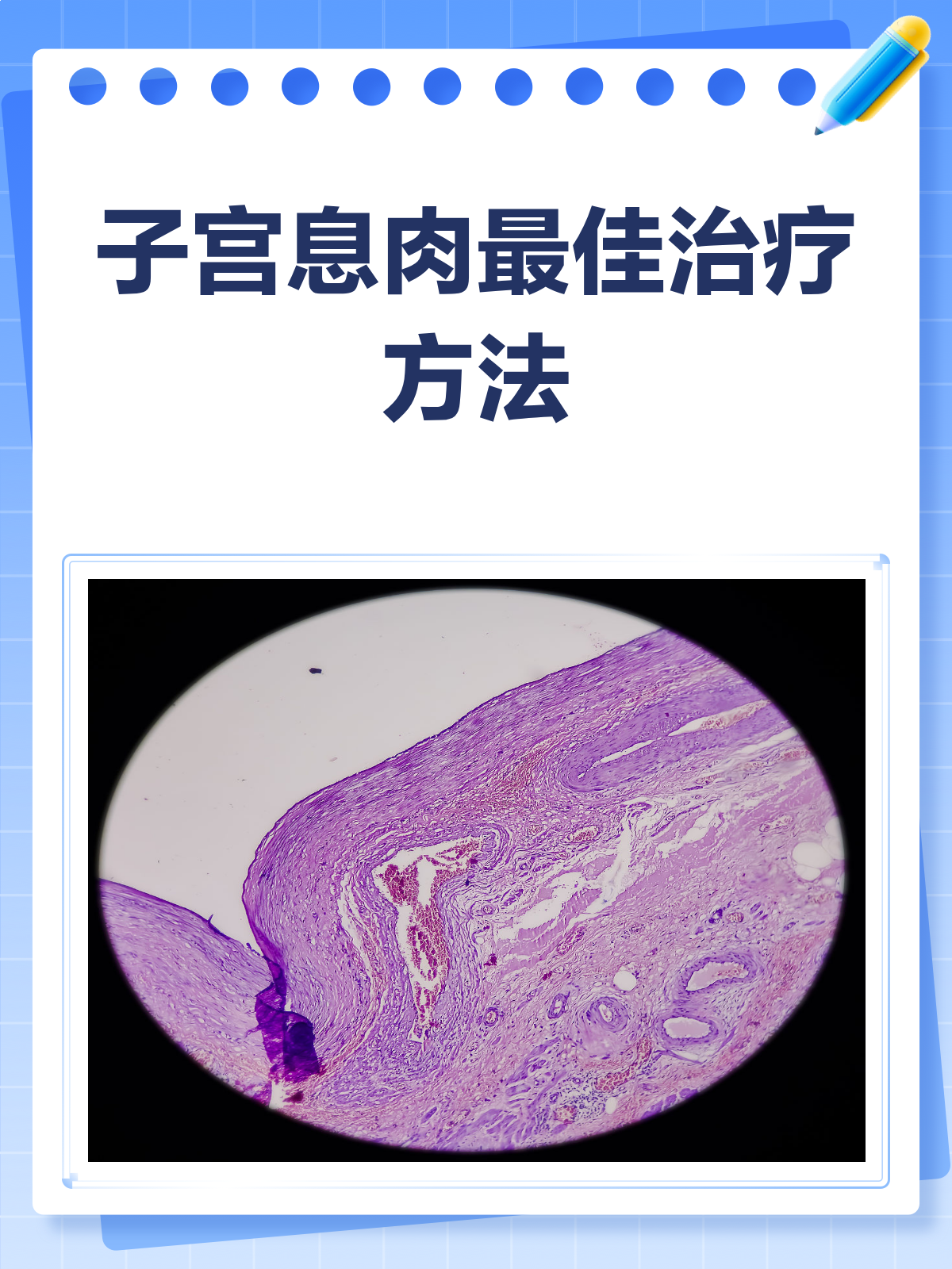 子宫息肉怎么治疗?这些方法帮你快速解决!