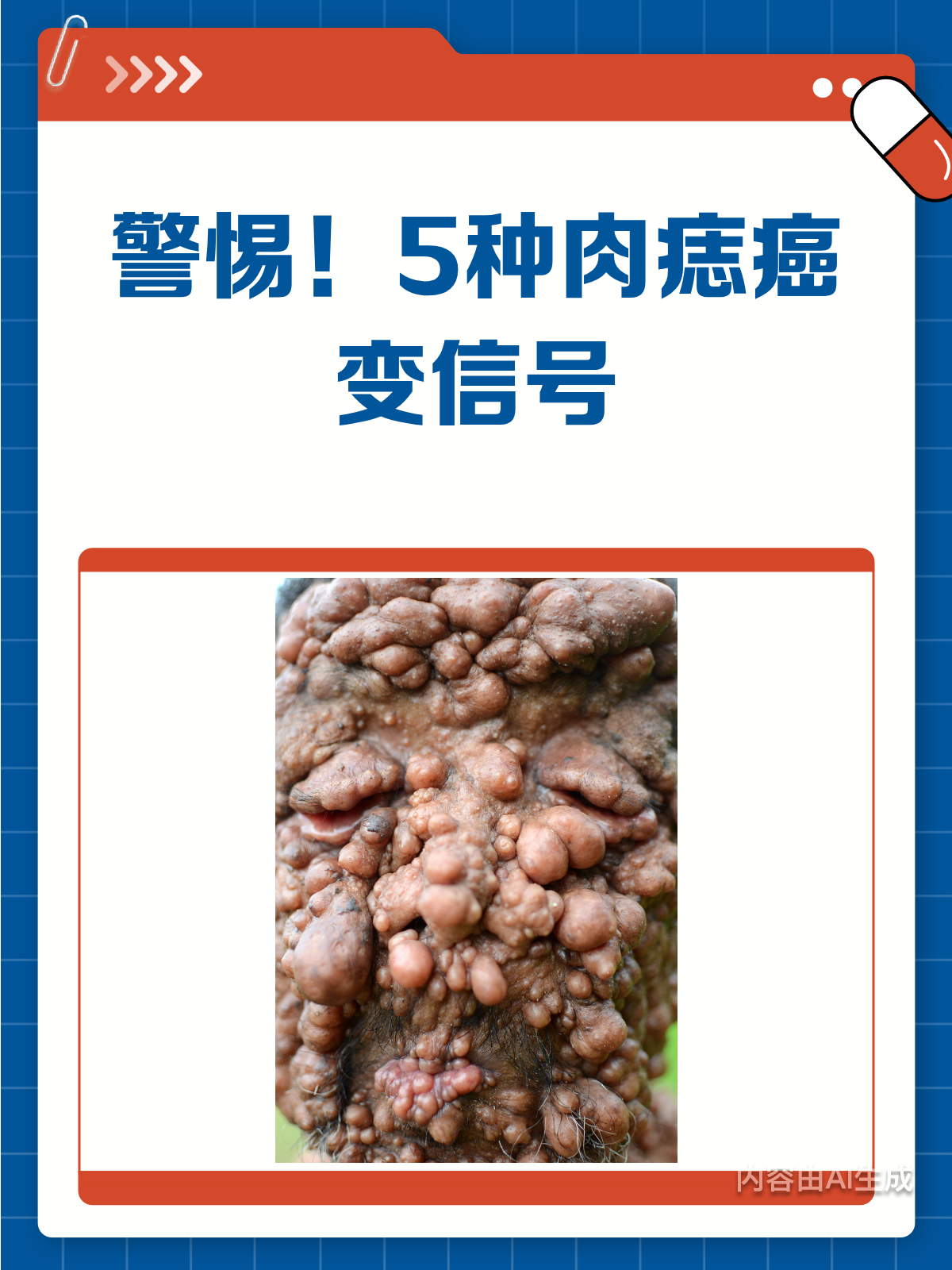 警惕!这5种肉痣可能是癌变的信号