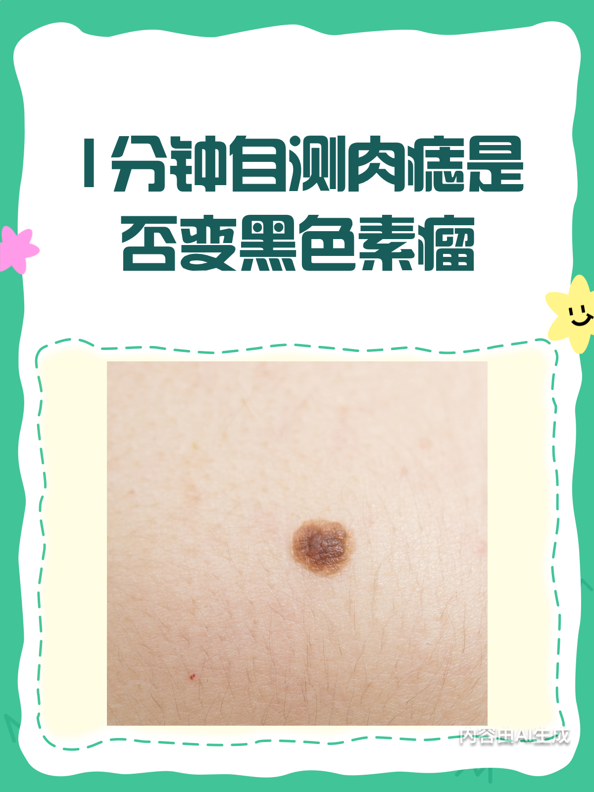 肉痣or黑色素瘤?1分钟自测法教你辨别!