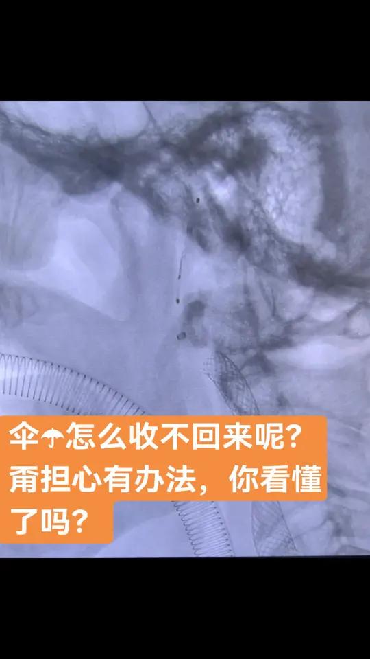 急诊颈动脉-大脑中动脉串联病变取栓患者,最后植入颈动脉支架后,发现保护伞无法靠收伞管完全回