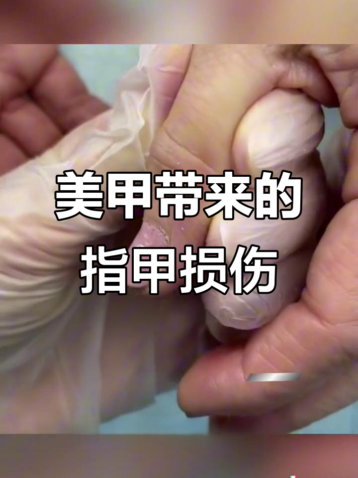 长期做美甲的危害,手指竟变这样!