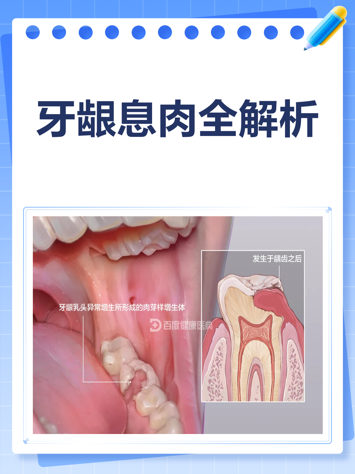 牙龈上的“不速之客”？揭秘牙龈息肉！