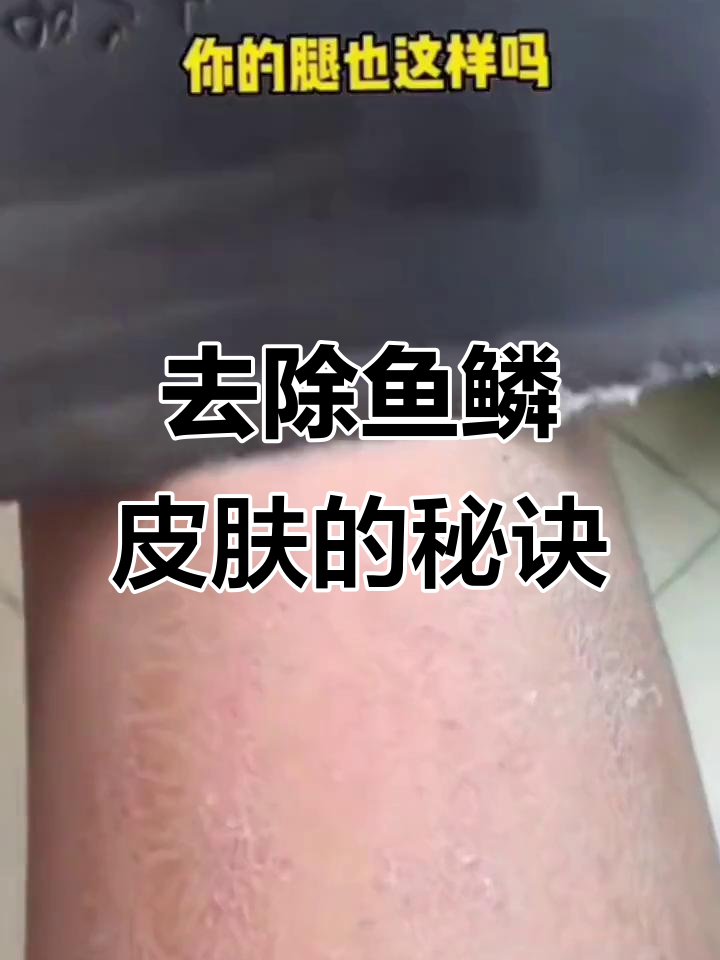 鱼鳞皮肤如何去除?秋冬必备蛇皮霜,轻松解决干燥问题