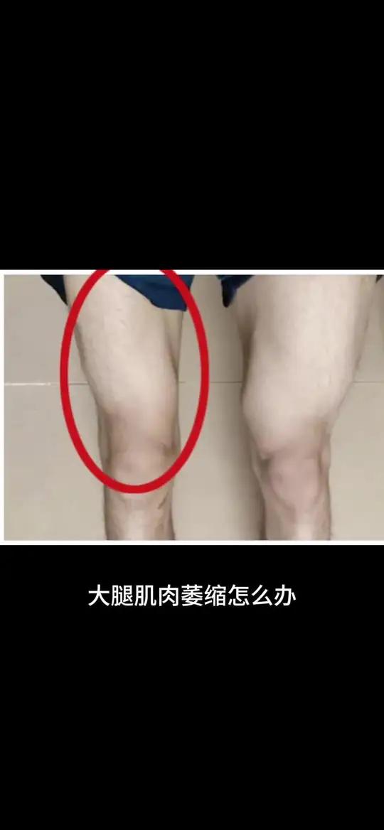 大腿肌肉萎缩怎么练