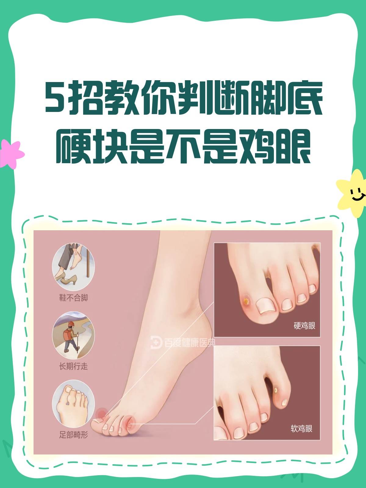 脚底长硬块？教你5招判断是不是鸡眼！