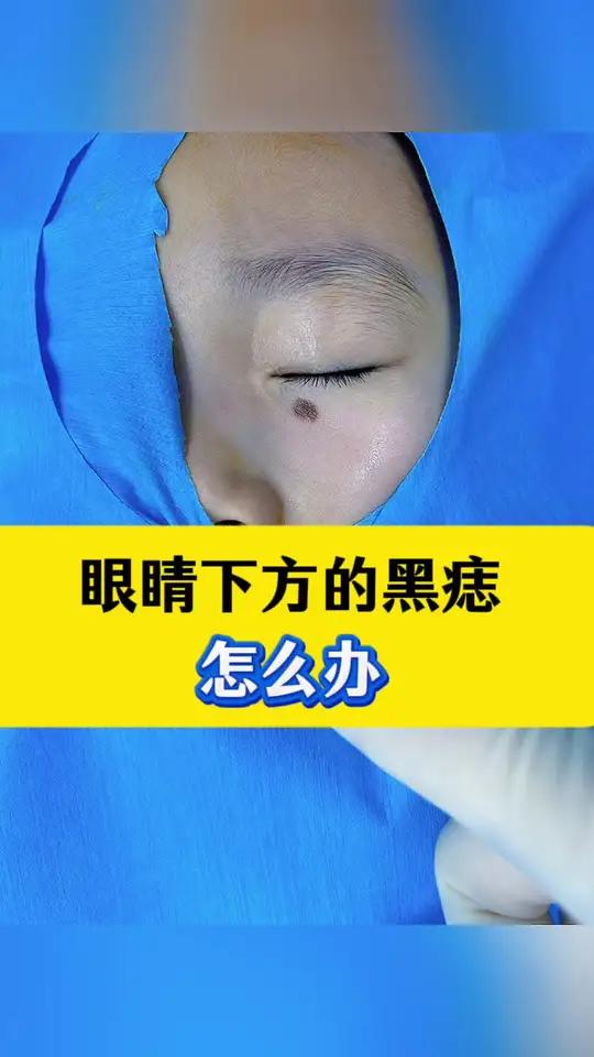 眼睛周围的黑痣