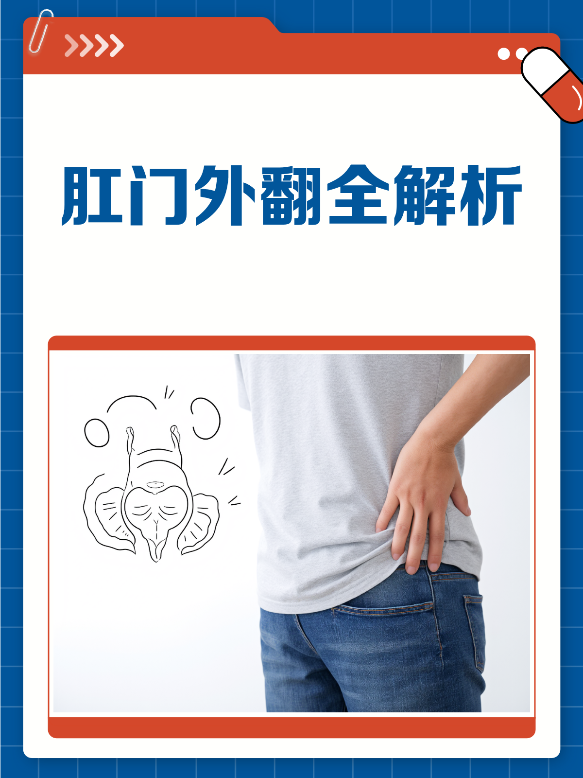 肛门外翻怎么办？教你如何应对！