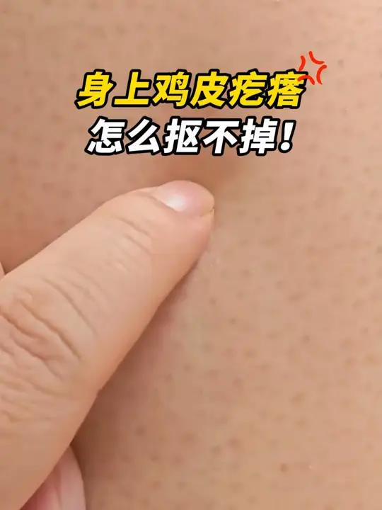 在胳膊、大腿上长出了这些凸起的小疙瘩,摸起来麻麻赖赖的也很不好看,三家皮肤科医生教你简单一