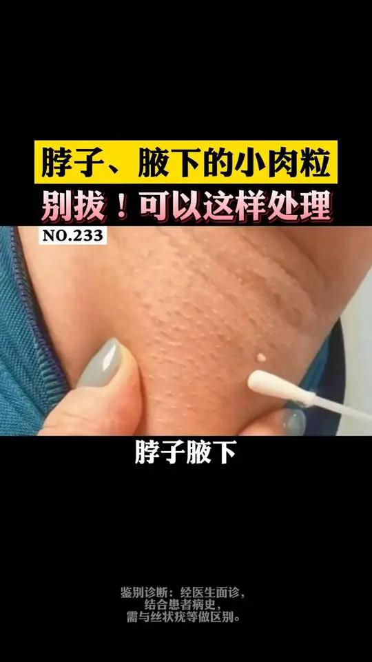 脖子腋下的小肉粒,千万别拔!可以这样处理