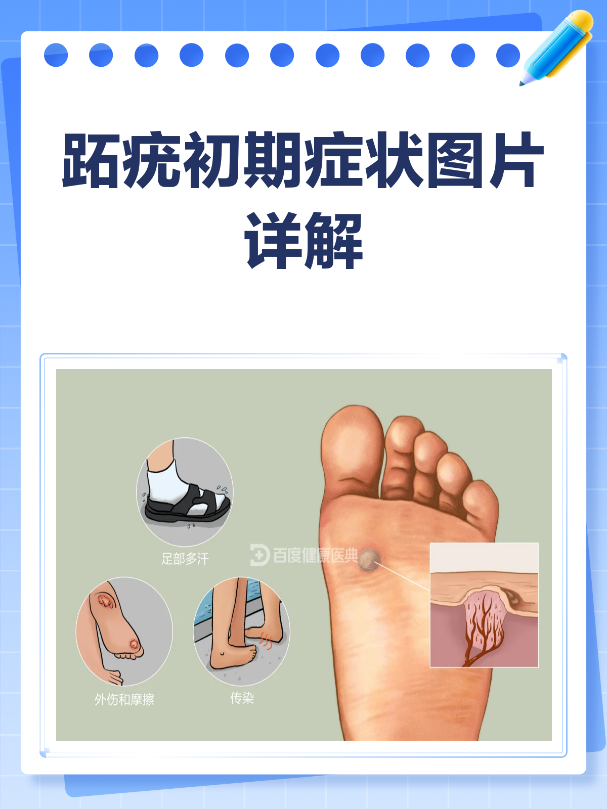 跖疣初期长啥样?一文带你认清它