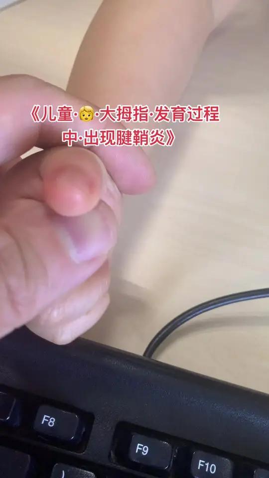 儿童大拇指腱鞘炎不能伸直 不能顶呱呱?1岁以下大多可以缓解,针对3岁以上长时间不能关节弯曲