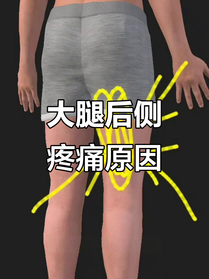大腿后侧酸疼紧绷?可能是肌肉劳损在作怪