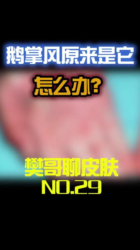 癣就是鹅掌风,怎么防止,一起了解下!