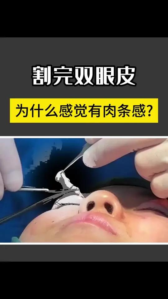 割完双眼皮为什么感觉会有肉条感