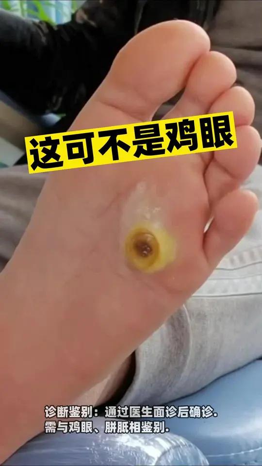 脚底长这种灰黄色的疙瘩,走路还疼,这可不是鸡眼,不及时处理还会越长越多,教你简单处理