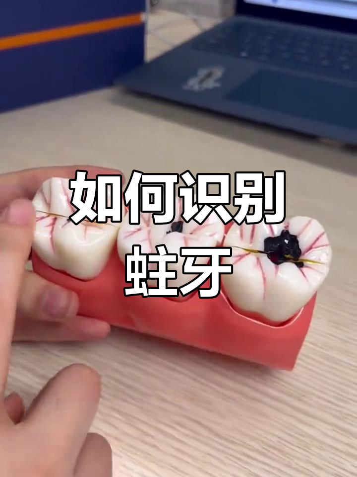 蛀牙的早期信号与治疗时机