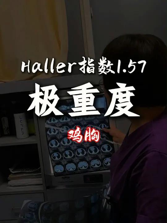 极重度鸡胸的孩子,有心肺功能受损的表现,已经做了手术,希望能够尽快恢复。鸡胸 健康科普 微