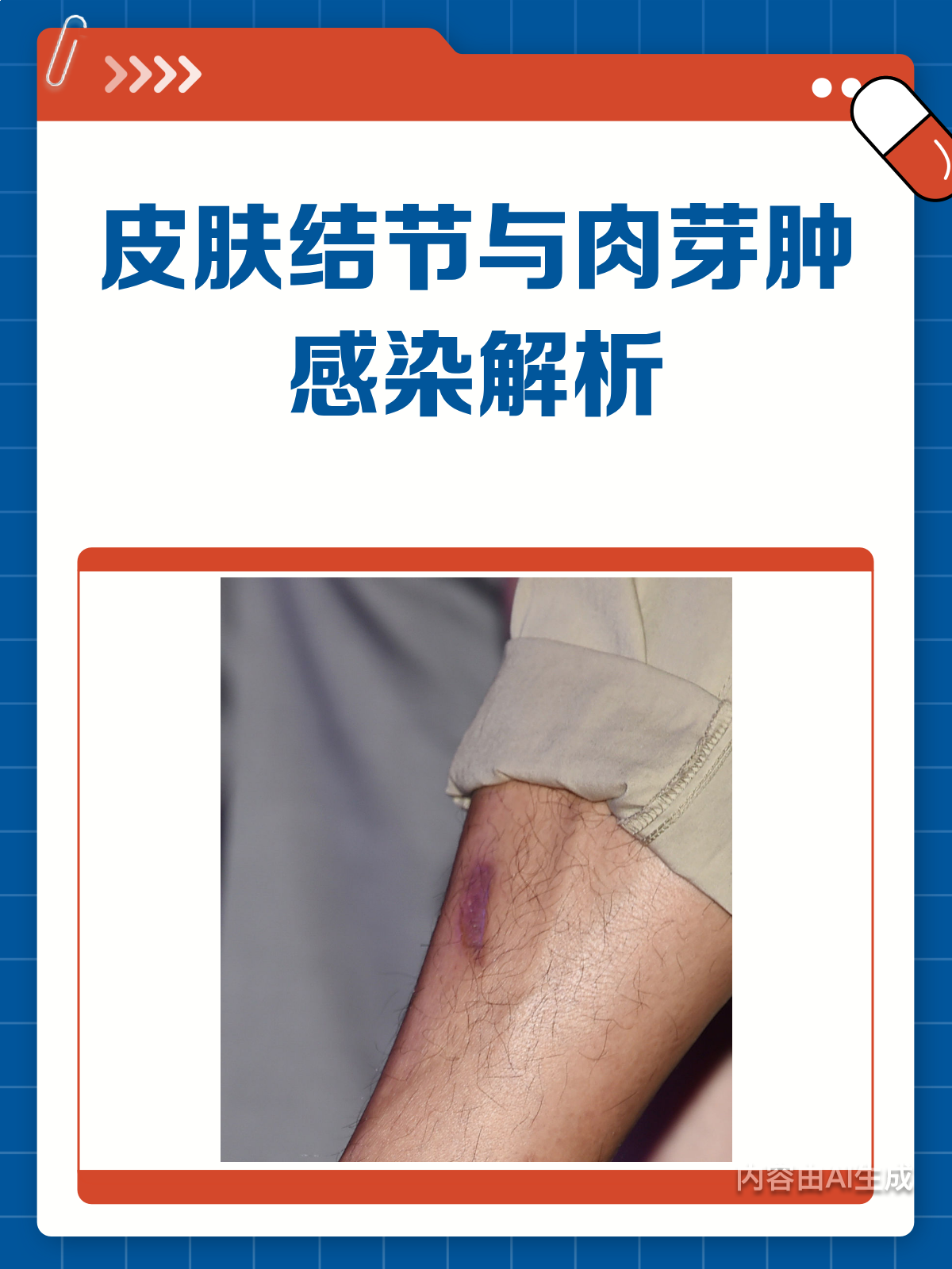 皮肤结节=肉芽肿感染一文给你讲清楚