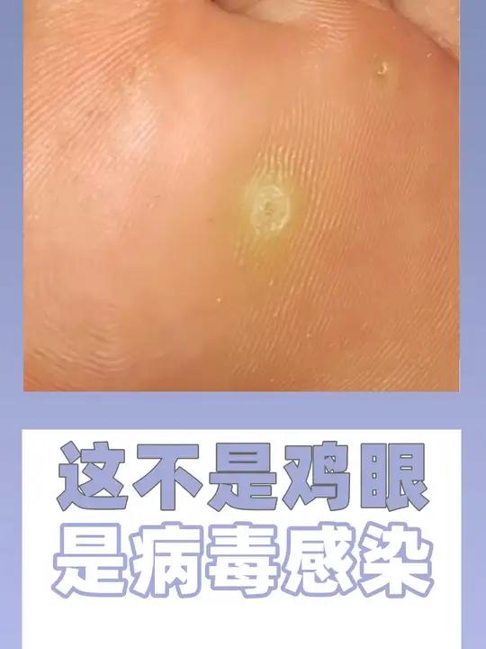 鸡眼和跖疣你会区分吗