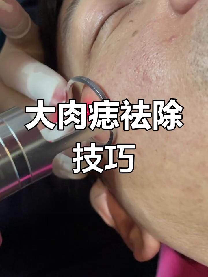 面部大肉痣去除方法