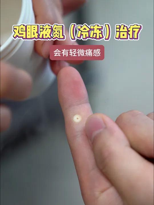 手部鸡眼液氮冷冻治疗