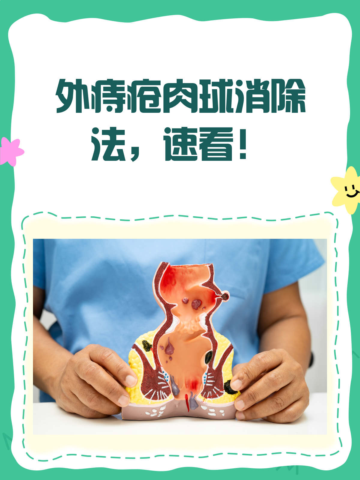 外痔肉球惹人烦？多管齐下巧消除！