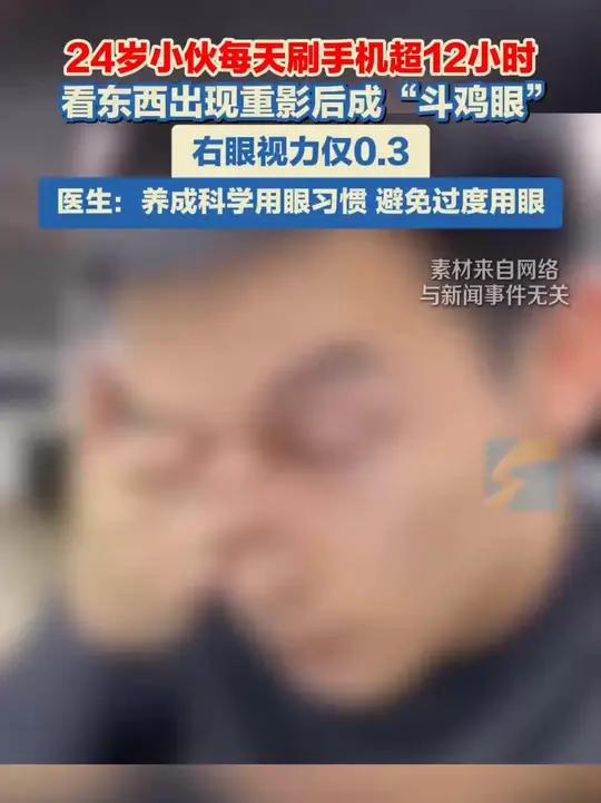 24岁小伙长期每天使用手机超过12小时,导致双眼视功能失衡,患上急性共同性内斜视,也就是俗