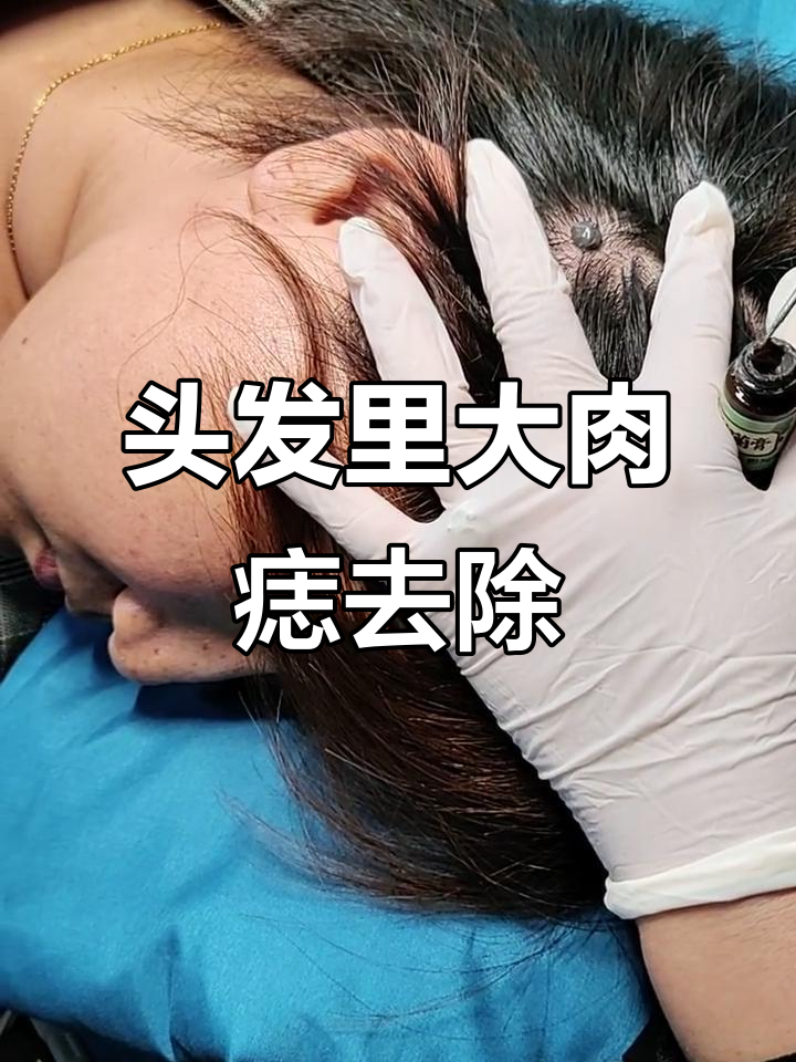 头发里的肉痣被成功提取，过程竟然这么惊心动魄