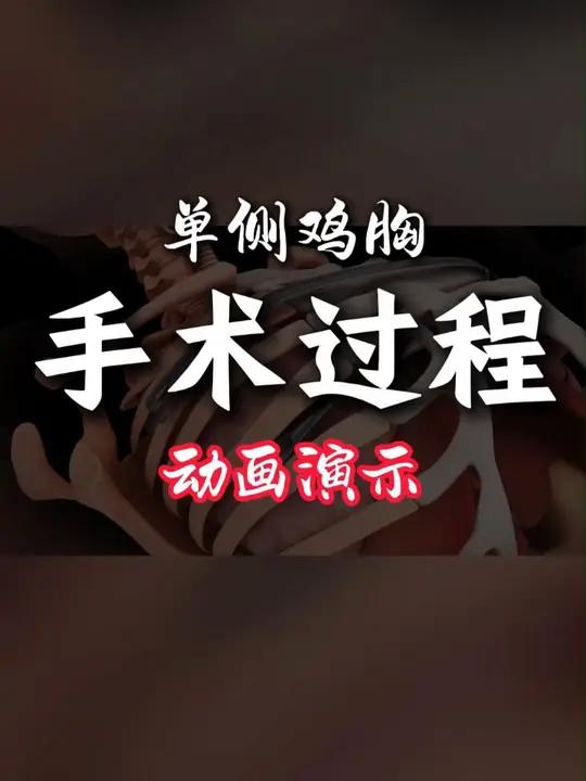 单侧鸡胸矫正手术动画演示,钢板放到哪里